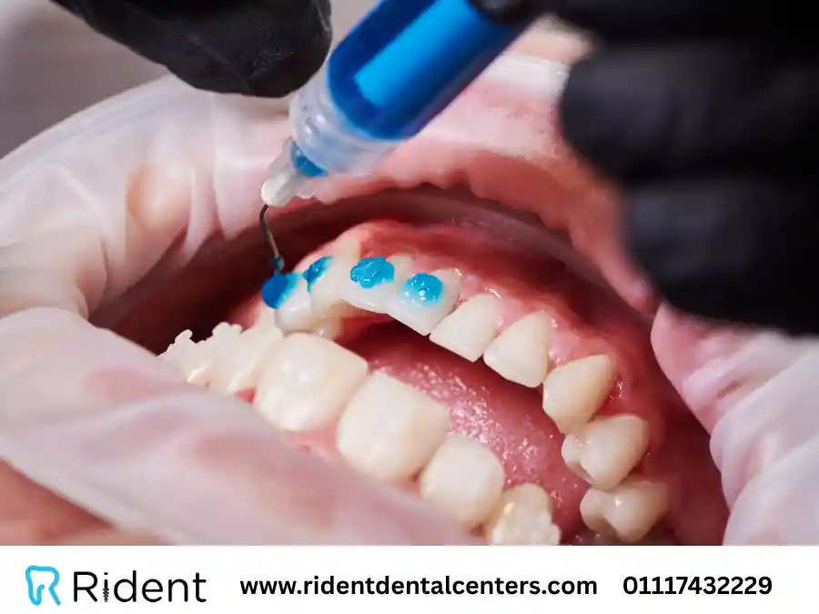 تحضير الاسنان قبل الفينير